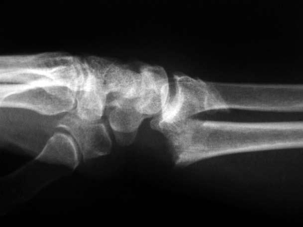 370 Acta Orthop Traumatol Turc (a) (b) (c) (d) Şekil 1. Altmış iki yaşındaki kadın hastanın (a, b) ameliyat öncesi ve (c, d) ameliyat sonrası üçüncü aydaki grafileri.