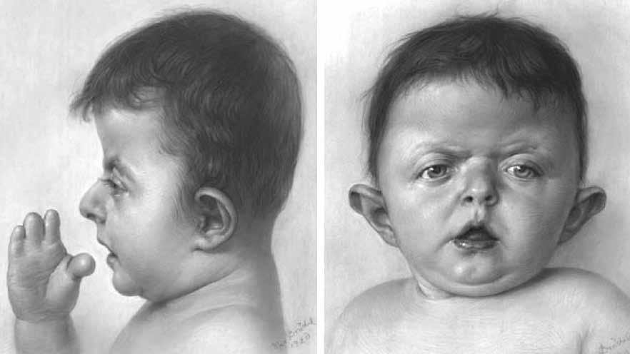 A b Şekil 3: a) İlk yayınlanan Apert Sendromundaki yüz görünümü. b) Crouzon Sendromunun ilk yayınlanan olgudaki yüz görünümü. (hipertelorizm) veya azalmasına (hipotelorizm) sebep olabilir (32,34,36).