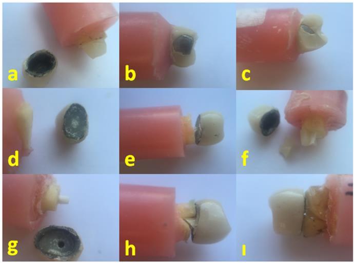 Kalan kron miktarının ve iki farklı fiber-post sistemlerinin endodontik tedavili dişlerin kırılma dayanımları üzerine etkisi Cilt 3 Sayı 3 Test sonucunda dişlerde oluşan kırık tipleri; ve diş