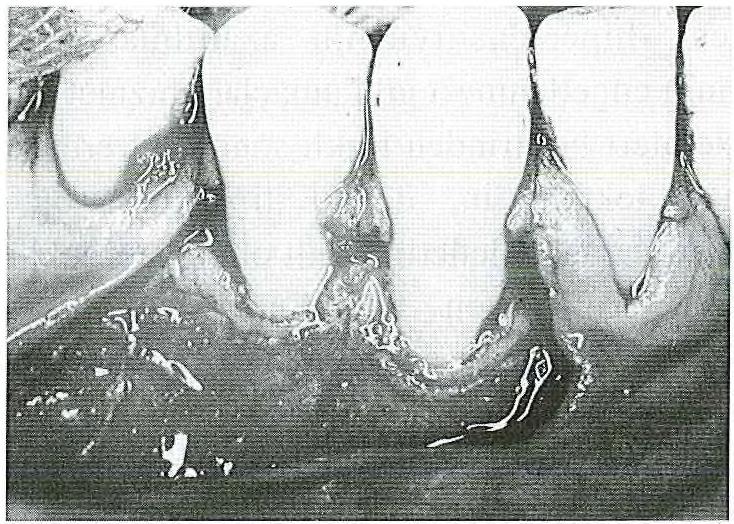 Operasyon öncesi tüm hastalara diş yüzeyi temizliği, oral hijyen eğitimi ve polittirii içeren başlangıç tedavisi uygulanmıştır. Resim 1. Alt sağ kanin ve 1.