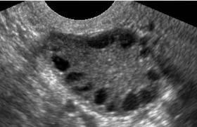 Pelvik Ultrasonografi (USG): HÜTF Radyoloji bölümünde, hastalara