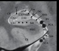 Hipokampal formasyon iç yapısı Şekil 2 de gösterilmektedir. Şekil 2. Hipokampusun histolojik (sol) ve T2A koronal görüntüsü(sağ).