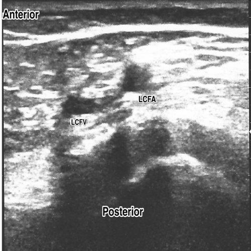 İnternal juguler ve femoral venlerin