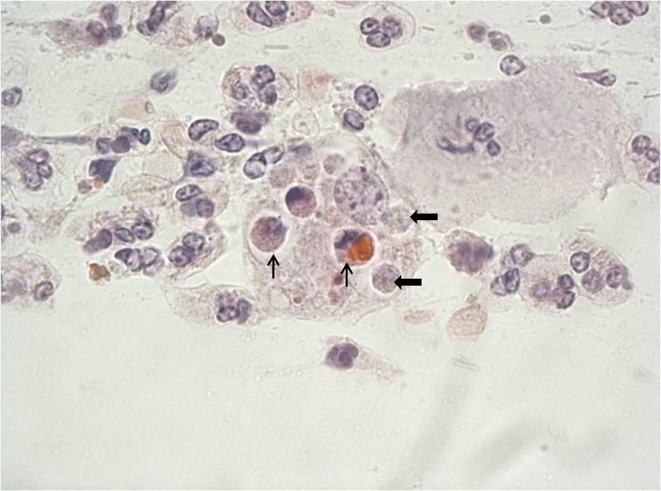 Şekil 4. 5: Makrofaj sitoplazmasında çok sayıda fagositik vakuol görülmektedir.