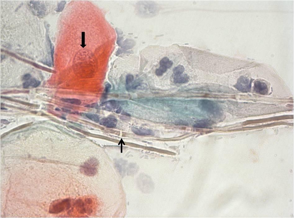 Şekil 4. 10: Skuamoz epitel hücrelerinin üzerinde Candida hifleri görülmektedir.
