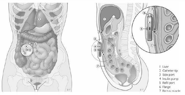 İmplantable Pump Continuous intraperitoneal insulin infusion (CIPII) 30 yılı aşkın bir süredir, ancak