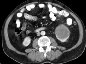 hacmi 398 cm³, metastazı olmayan, T2N0MO, klinik