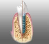 Gerekli faktör replasmanları ve medikal tedavi ile kanama kontrolü sağlanarak diş çekimi yapılan hastaların, sonraki dönemde dişsizlik durumları da göz önünde bulundurulmalıdır.