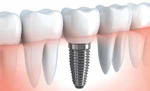 Başarılı bir multidisipliner yaklaşımın ardından uygun şartlar sağlandığında hemofili hastalarında sağlıklı bireylerdekilerden fark olmaksızın dental implant uygulamaları yapılabilmektedir.