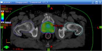 23 Merkezi kesit görüntüsü Üç- boyutlu planlama yapılırken tedavi edilecek anatomik bölgenin çekilmiş BT görüntüleri içinden PTV nin