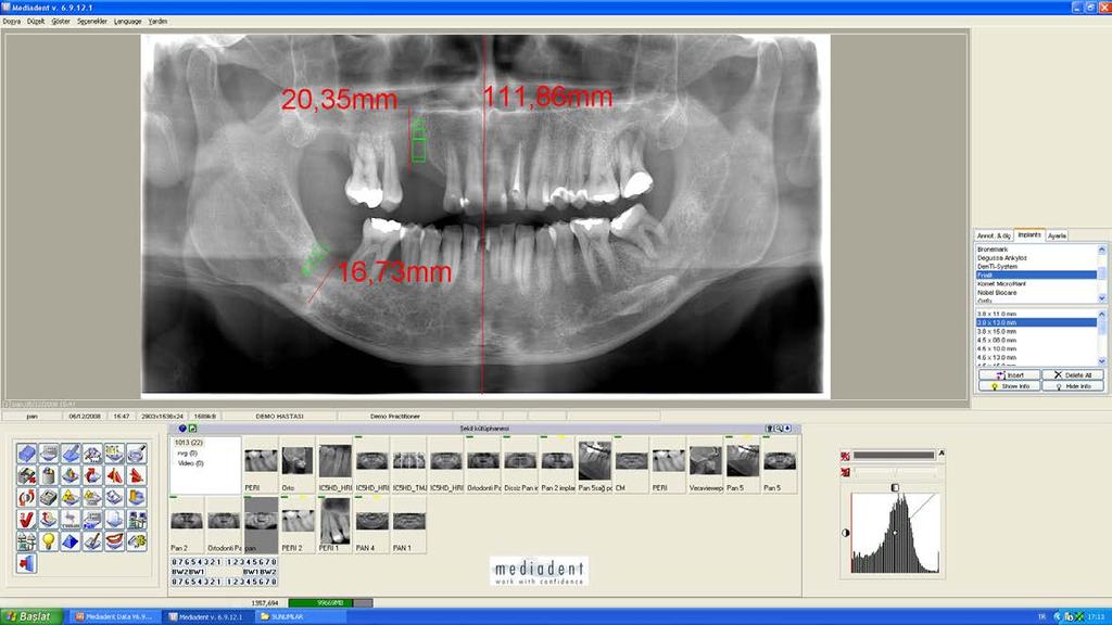 CİHAZIN MEKANİK ÜSTÜNLÜKLERİ C Kolu ile ilgili Özellikler Birebir ölçekli ölçüm ve implant planlama imkanı Çekilen görüntü otomatik