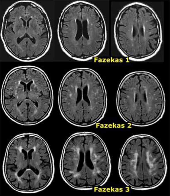 Fazekas; AJR Am J Roentgenol.