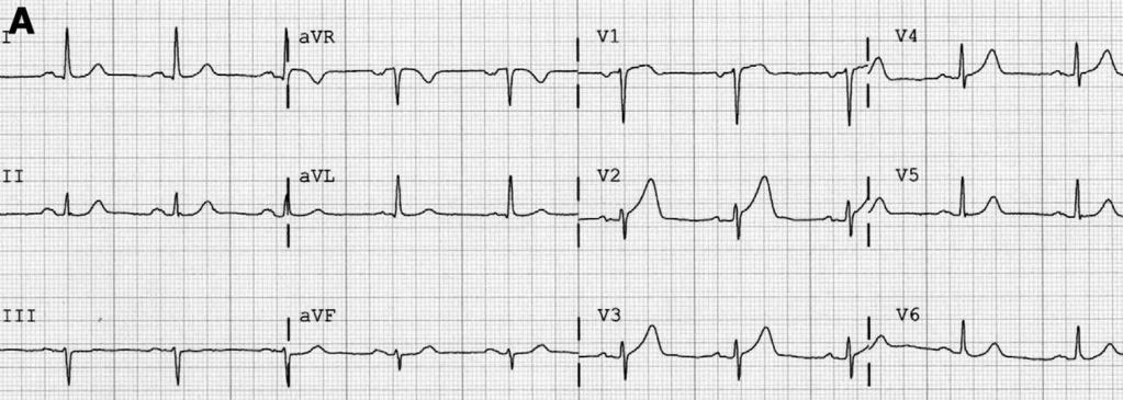 STEMI veya benign erken