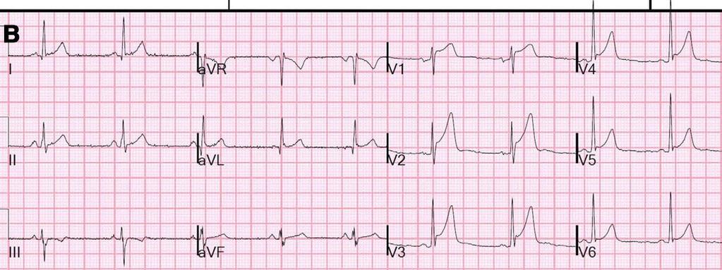 STEMI veya benign erken