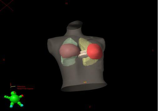 Tomografi görüntüsünün dıģ vücut konturu ve akciğerler tedavi planlama sisteminin otomatik konturlama seçeneğinden faydalanılarak TPS tarafından çizildi.