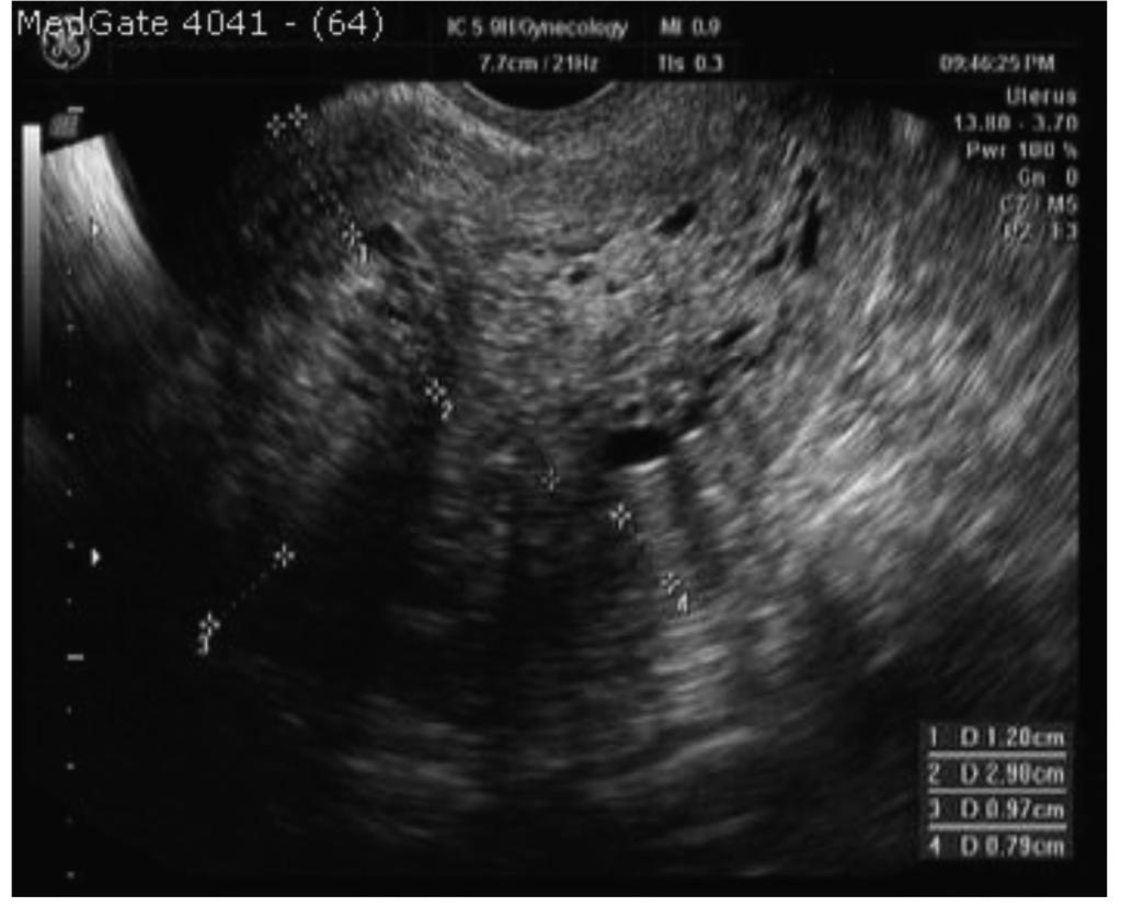 invazyon olarak not edildi. BULGULAR fiekil 2 Endometrium ca hastas n n transvaginal USG ile de erlendirilmesi. 1.