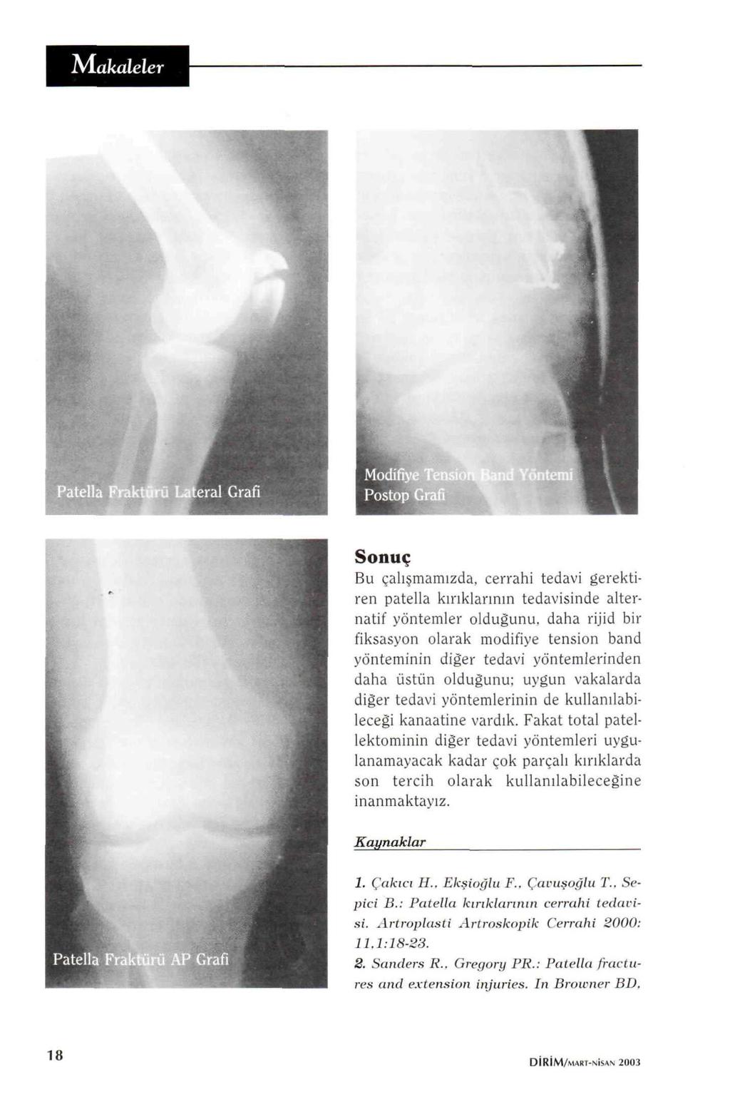 Makalele Modifiye 1 Postop Grafi Sonuç Bu çalışmamızda, cerrahi tedavi gerektiren patella kırıklarının tedavisinde alternatif yöntemler olduğunu, daha rijid bir fiksasyon olarak modifiye tension band