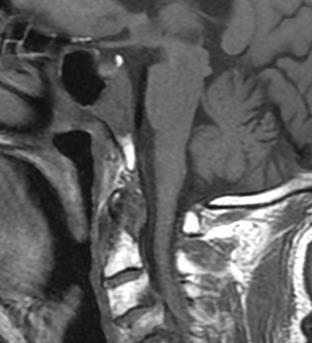 (b) Bir sonraki tetkikte hastanın klivus posterior kesiminde izlenen hipointens lezyonun büyüdüğü