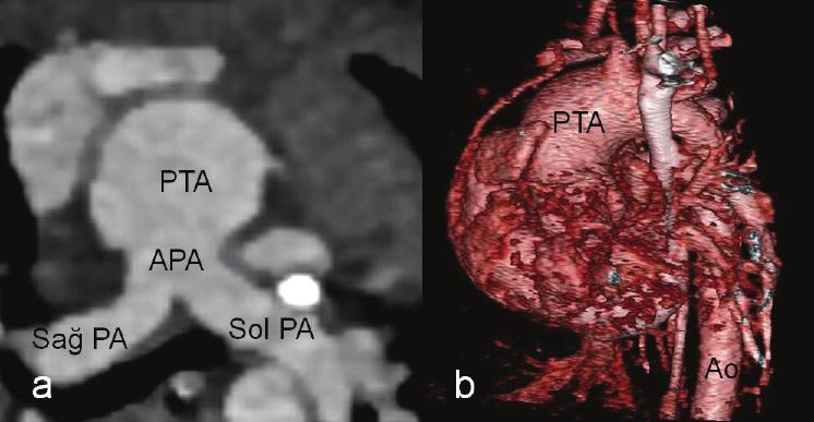 Bu sınıflamada eski sınıflamadaki tip IV alınmamıştır çünkü akciğerler majör aorto-pulmoner kollateral arterlerle (MAPKA) kanlanır, bu görünüm VSD + Pulmoner atrezi seklinde tanımlanmıştır (Resim 4).