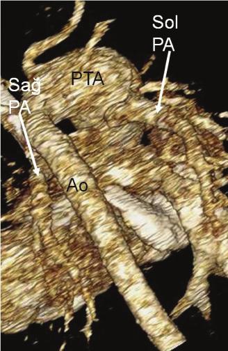 pa:pulmoner arter; Ao: Aorta Eşlik Eden Anomaliler Olgulara başka kardiyak anomaliler de eşlik edebilmektedir. %10-30 vakada aortik ark anomalileri eşlik eder (9).