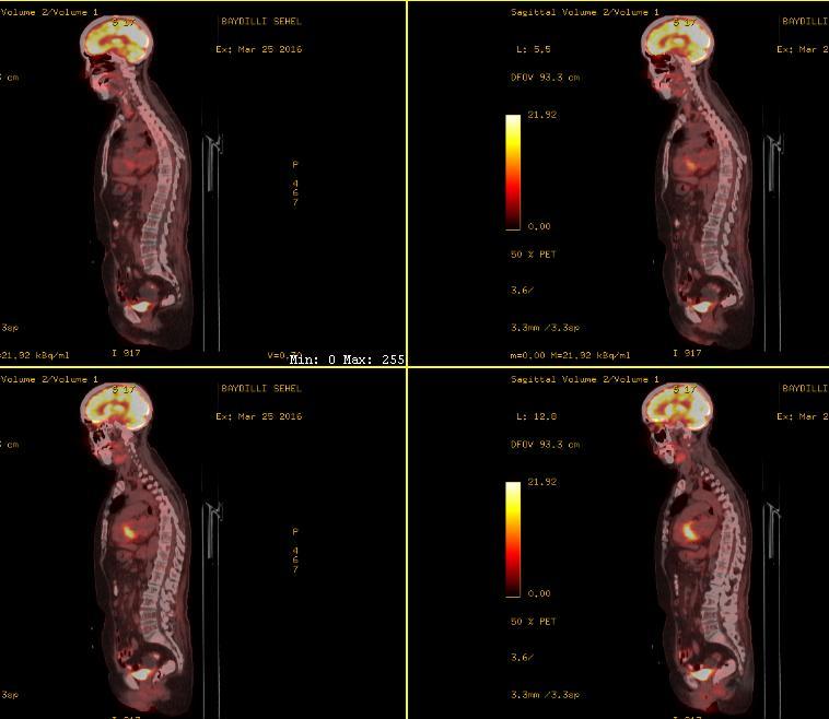 PET-CT; 3.