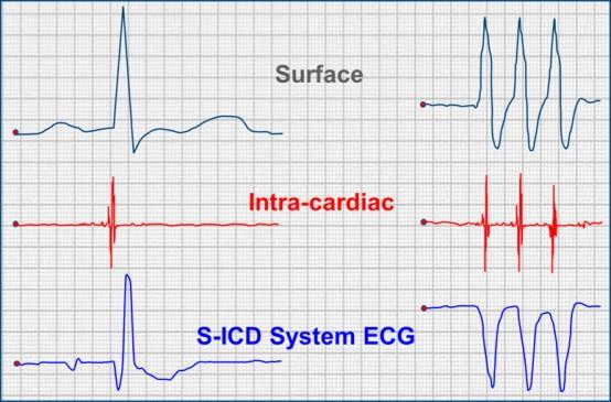 Faz 1 Detection Subkütan sinyal sense edilmesi FAZ II: Certification Kalp hızına karar