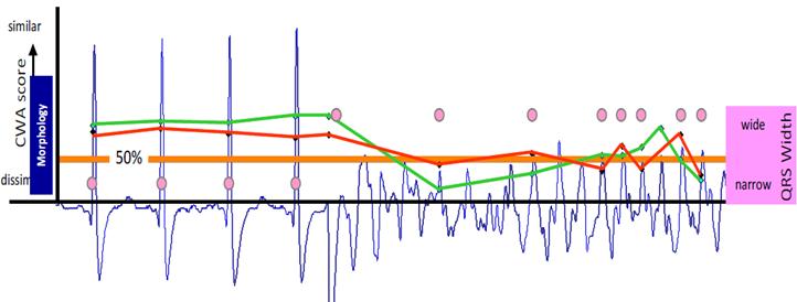 S-ICD Ritm Diskriminasyonu: VT/VF Statik morfoloji (kırmızı çizgi) ve dinamik morfoloji (yeşil