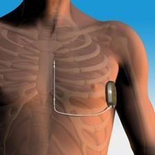 TV-ICD vs S-ICD DEZAVANTAJLAR Cep enfeksiyonları Jeneratör komplikasyonları Uygunsuz şoklar Sistemik enfeksiyon riski Ven trombozu/stenozu Lead fraktürü