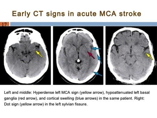 Kontrastsız BT Erken iskemi bulguları Oklüzyon olan arterde dansite artışı Hiperdens orta serebral arter (MCA) işareti Hiperdens