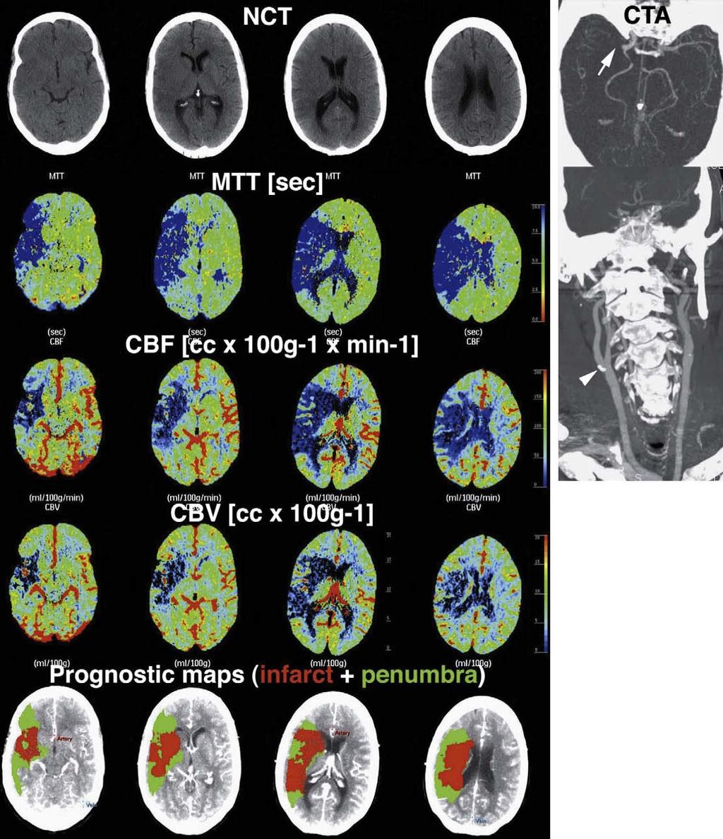 Multimodal BT A 57 year-old male with a right MCA syndrome underwent CT.