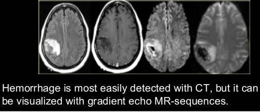 sekanslar BT kadar duyarlı Akut inmede MRG tek görüntüleme yöntemi olarak kullanılabilir MRG hemoraji Farklı belirtileri olan