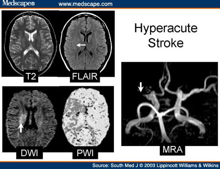 Multimodal MR Six-Minute Magnetic Resonance Imaging Protocol for Evaluation of Acute Ischemic Stroke