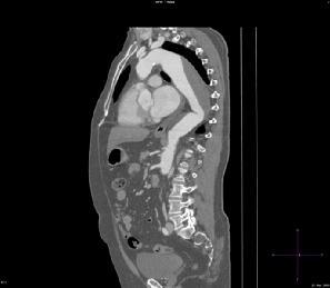 OLGU: 60 Y, E, STENT GREFT 1 a b Resim 17: