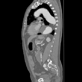 7. OLGU: 64 Y, E, STENT GREFT 1 a b Resim 20: