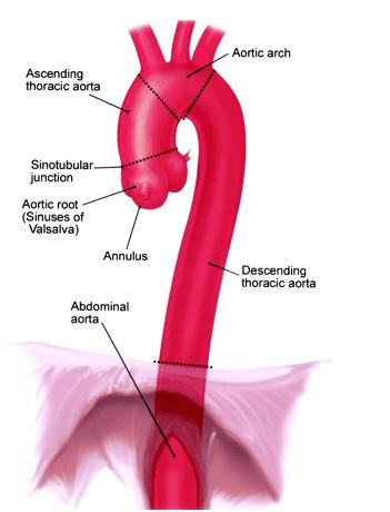 Kronik Tip B Disseksiyon Psödoanevrizmalar Aortobronşial fistül (2,3) Şekil 1: Torasik Aort Anatomisi 2.2.1. TORASİK AORT ANEVRİZMALARI: 2.2.1.1. AORT ANEVRİZMALARININ HİSTOPATOLOJİ ve ETİYOLOJİSİ: Histolojik olarak aort 5 farklı tabakadan oluşur.