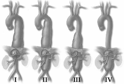 İnen torakal aort anevrizmaları (TAA), sol subklavyan arterin hemen distali ile diafragma düzeyi arasındaki aortik segmenti etkiler (14).