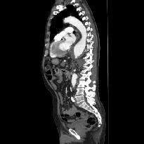 Resim 1: Torakoabdominal aort