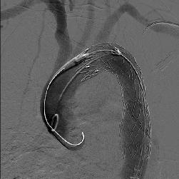 (b) Stent greftin açılması sırasında proksimal kesim kapalı