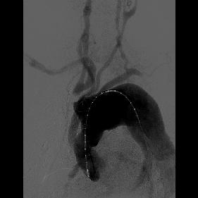 3. OLGU: 61 Y, E, STENT GREFT 1 a b c d Resim 8: Kronik arkus aort disseksiyonu