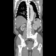 reformat, (b) aksiyel imajda ve (c) koronal reformat görüntülerde abdominal