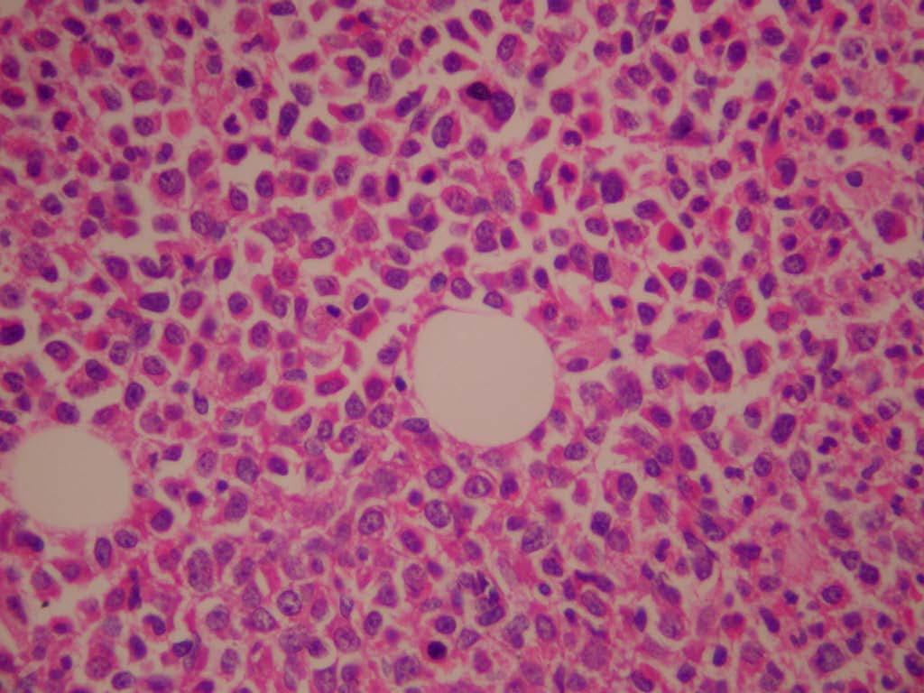 Granülositik hiperplazi Eosinofili gözlenebilir
