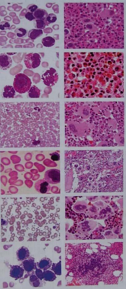 KML ABL1 Eosinofilili myeloid neoplaziler Polistemia Vera PDGFRA, PDGFRB, FGFR1 JAK2V617F Primer