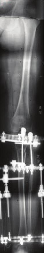 Eksternal fiksatörle YTO hastasının ameliyat sonrası ikinci yıldaki AP ortoröntgenografisi ve deformite analizi. [Bu şekil, derginin www.aott.org.