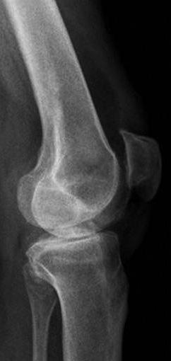 sonrası AP grafisi, (d) Plakla açık kama osteotomi hastasının ameliyat sonrası lateral grafisi. sından da anlamlı farklılık gözlenmedi.