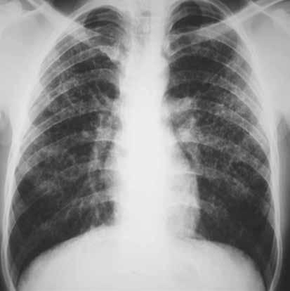 Yaygın kciğer Hastalıklarında Radyografi 91 fibrozisi yoktur. kciğer hacmi azalmamıştır. Çoğu hastada akciğer hacmi artar. Üst lob dağılımı bazal kesimlere göre daha ağırlıklıdır (Resim 17, ) [24].