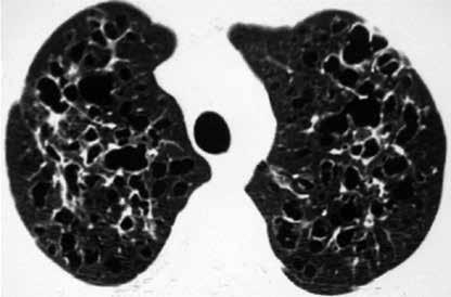 İdiopatik interstisyel fibrozisli olguda retiküler değişiklikler alt loblarda ağırlıklı izlenmekte. kciğer hacimlerinde azalma dikkati çekmekte. çok sayıda küçük nodüller vardır.