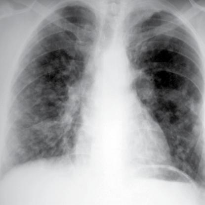 Yaygın kciğer Hastalıklarında Radyografi 93 Resim 20. Meme kanserli olguda değişik boyutlarda keskin konturlu metastatik nodüller. Resim 21.