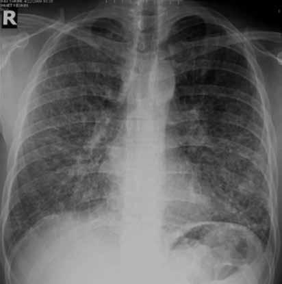 94 Özkan R. Resim 23.,. () erilyozis tanılı hastada radyografide Kerley çizgileri nodüler şekilde görülmekte, her iki hiler bölgedeki damar konturları net olarak seçilememekte.
