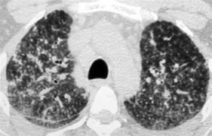 [3]. Reed JC. Chest Radiology. Plain film patterns and differential diagnosis, 4th ed. Mosby, 1997: 229. [4]. Webb WR, Higgins C. Thoracic imaging. Pulmonary Williams&Wilkins, 2011: 32-5. [5].