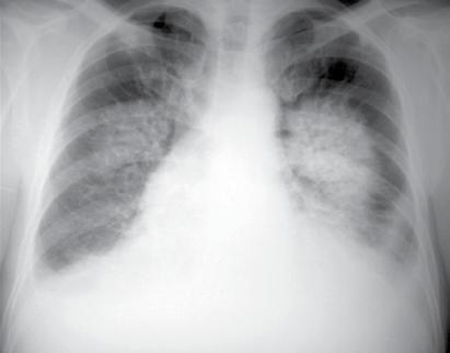Yaygın kciğer Hastalıklarında Radyografi 83 Resim 1.,. () Subaraknoid kanama nedeni ile gelişen akciğer ödemine bağlı yaygın konsolidasyon izlenmekte.